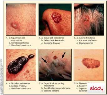 cancer piele solar ultraviolete